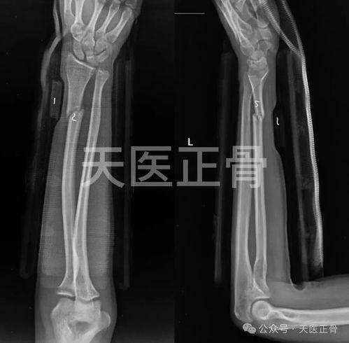 骨折石膏视频,骨折石膏固定术操作步骤及注意事项解析