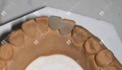 备牙视频,牙科手术前的准备与技巧解析